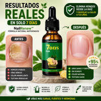 NailRenew™– Adiós hongos en uñas, resultados en solo 1 semana